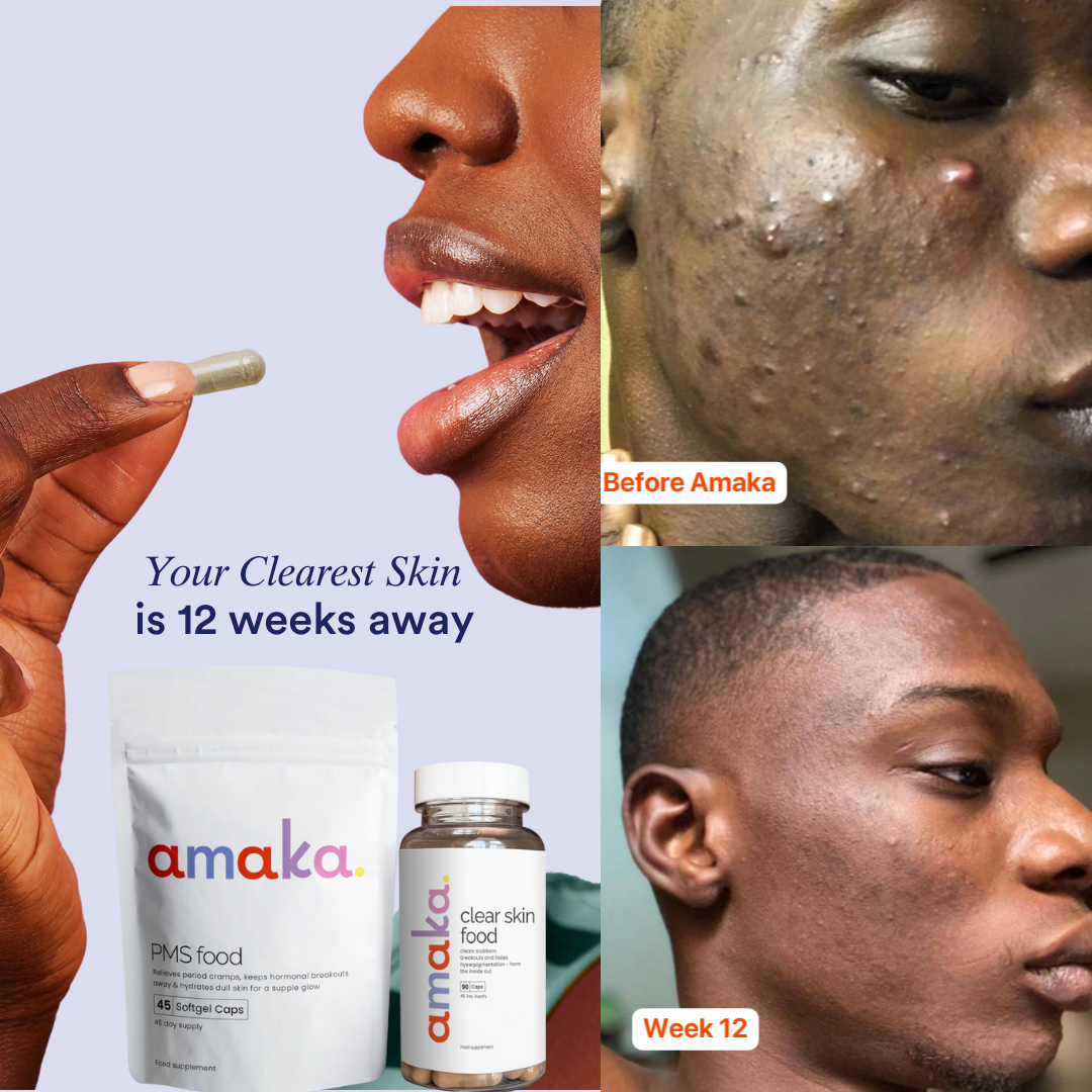 12-week Clear Skin Bundle